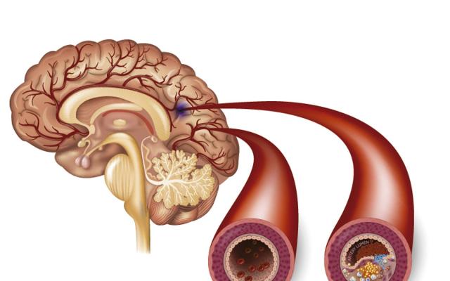 Diagrama del accidente cerebrovascular (ACV) isquémico