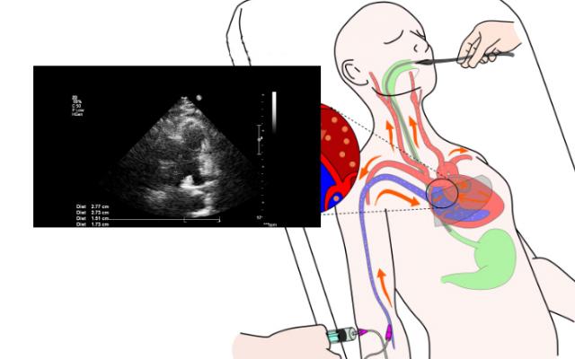 Ecocardiograma Transesofágico: Procedimiento – Bupa Latam