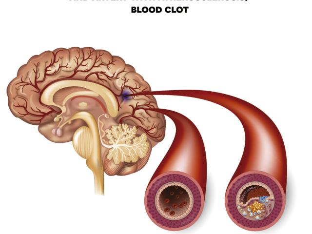 Diagrama del accidente cerebrovascular (ACV) isquémico