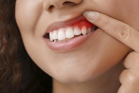 Mujer con encías inflamadas